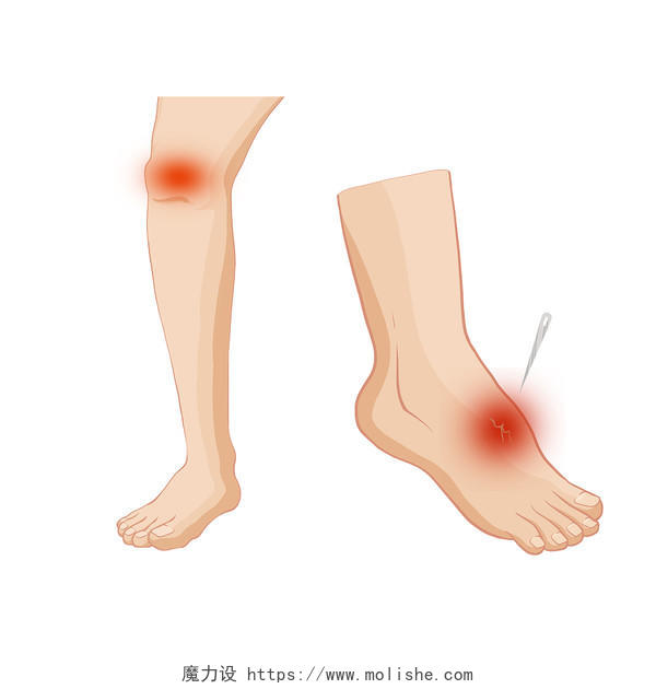 手绘红肿的脚关节疼病刺痛图标元素膝盖痛风湿疼痛元素